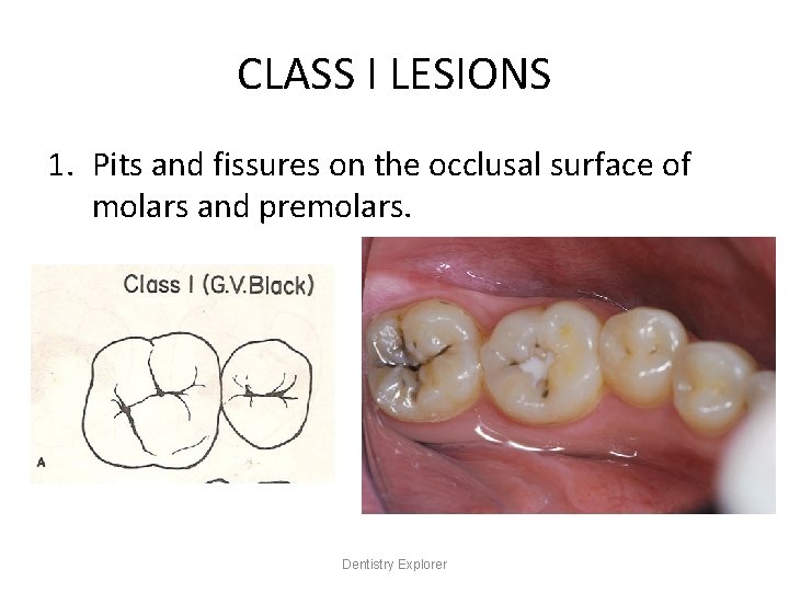 CLASS I LESIONS 1. Pits and fissures on the occlusal surface of molars and
