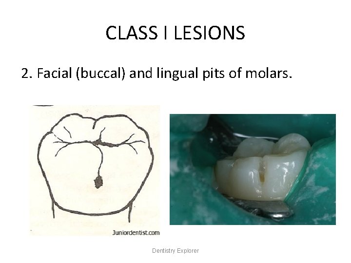 CLASS I LESIONS 2. Facial (buccal) and lingual pits of molars. Dentistry Explorer 