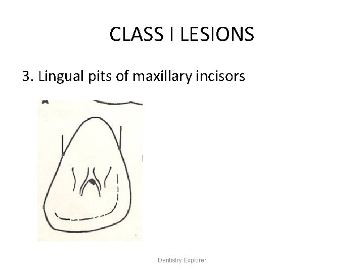 CLASS I LESIONS 3. Lingual pits of maxillary incisors Dentistry Explorer 