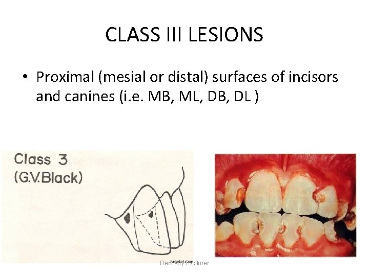 CLASS III LESIONS • Proximal (mesial or distal) surfaces of incisors and canines (i.