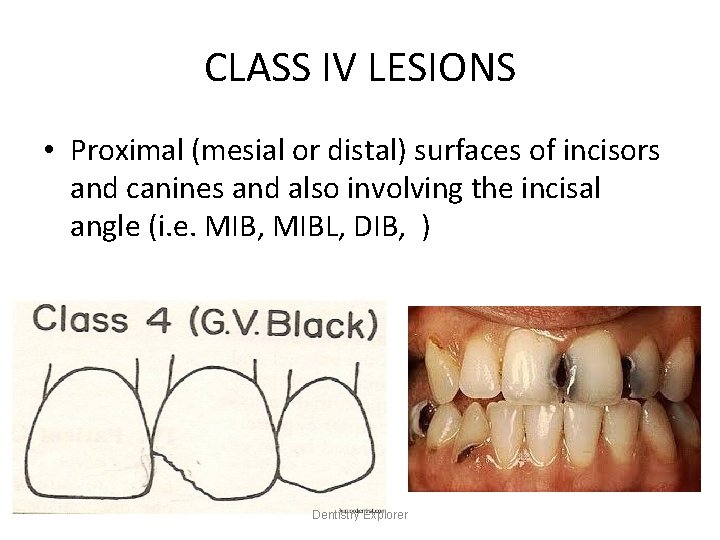 CLASS IV LESIONS • Proximal (mesial or distal) surfaces of incisors and canines and