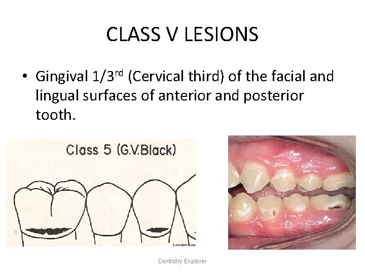 CLASS V LESIONS • Gingival 1/3 rd (Cervical third) of the facial and lingual