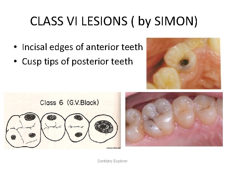 CLASS VI LESIONS ( by SIMON) • Incisal edges of anterior teeth • Cusp