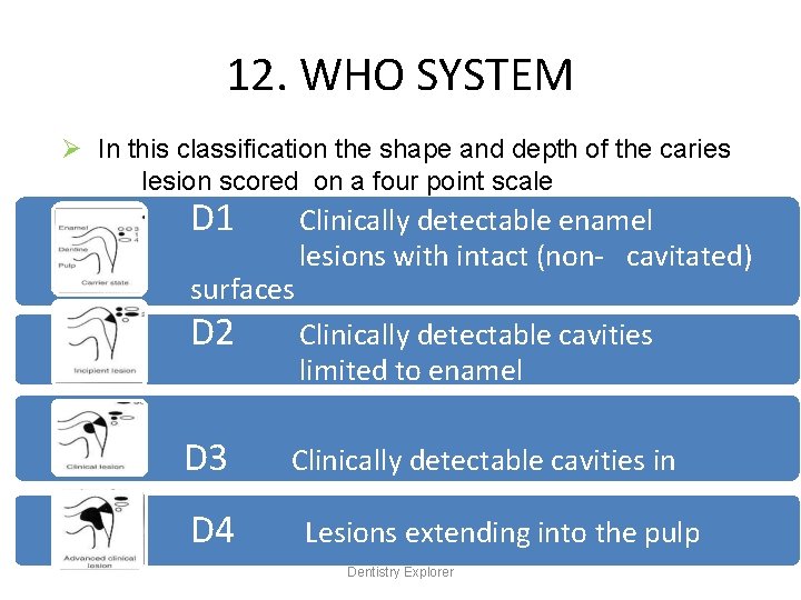 12. WHO SYSTEM Ø In this classification the shape and depth of the caries