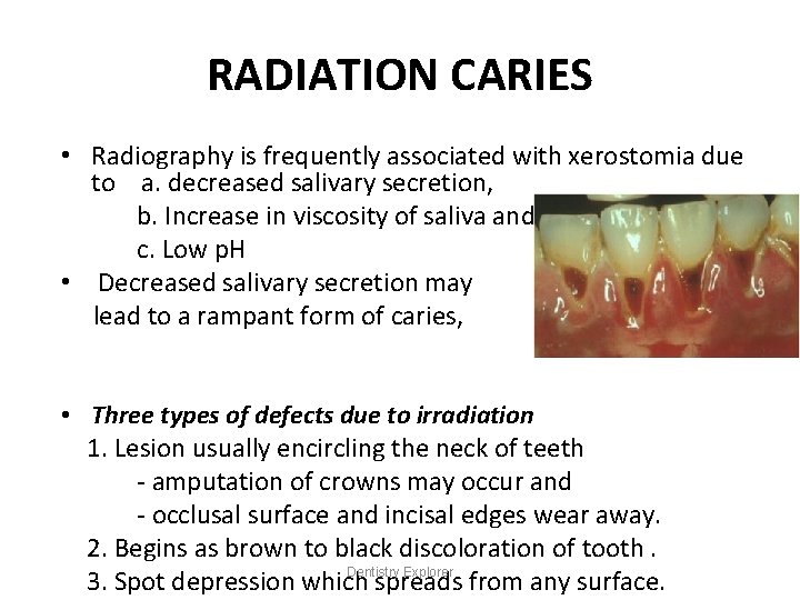 RADIATION CARIES • Radiography is frequently associated with xerostomia due to a. decreased salivary