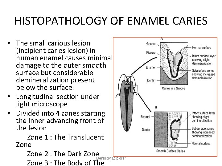 HISTOPATHOLOGY OF ENAMEL CARIES • The small carious lesion (incipient caries lesion) in human