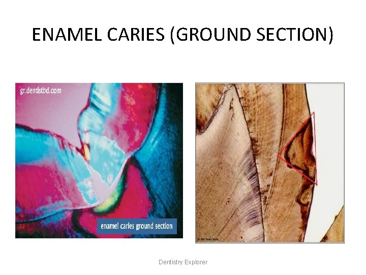 ENAMEL CARIES (GROUND SECTION) Dentistry Explorer 