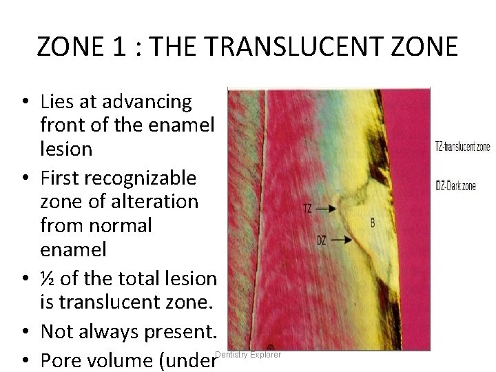 ZONE 1 : THE TRANSLUCENT ZONE • Lies at advancing front of the enamel