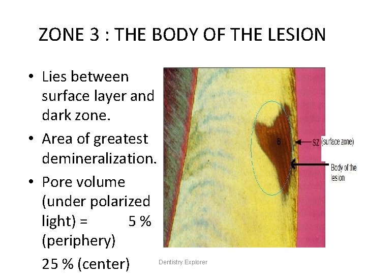 ZONE 3 : THE BODY OF THE LESION • Lies between surface layer and