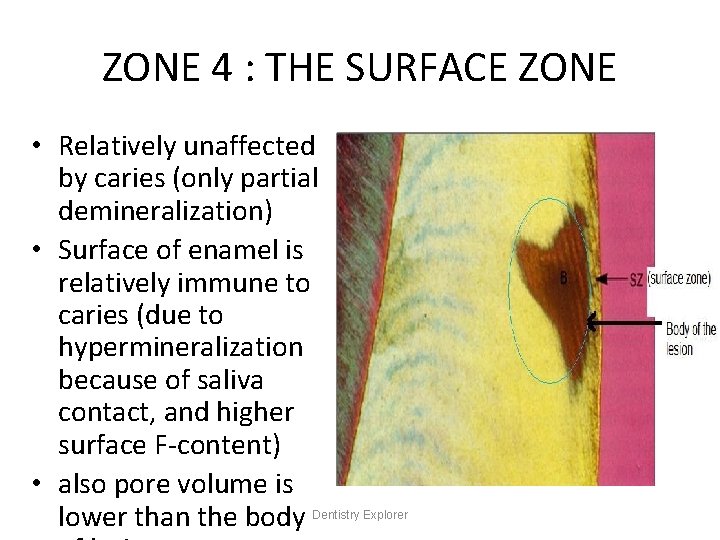 ZONE 4 : THE SURFACE ZONE • Relatively unaffected by caries (only partial demineralization)