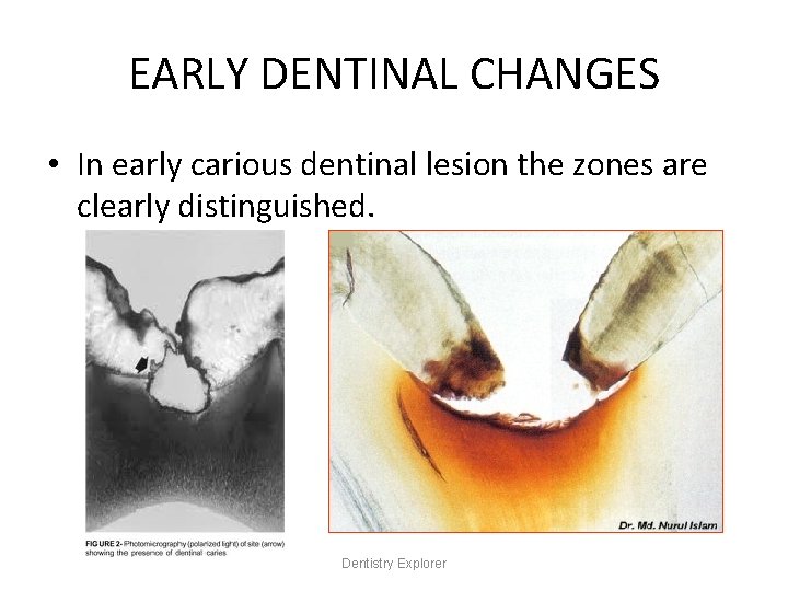 EARLY DENTINAL CHANGES • In early carious dentinal lesion the zones are clearly distinguished.