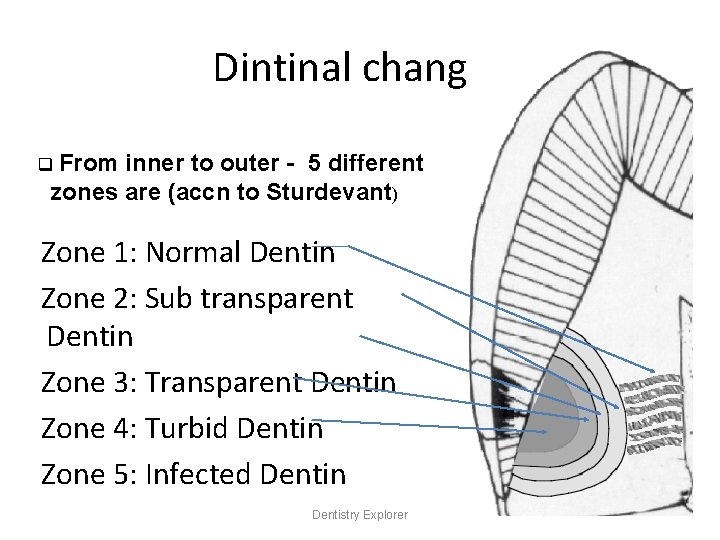 Dintinal changes q From inner to outer - 5 different zones are (accn to