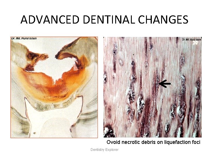 ADVANCED DENTINAL CHANGES Ovoid necrotic debris on liquefaction foci Dentistry Explorer 
