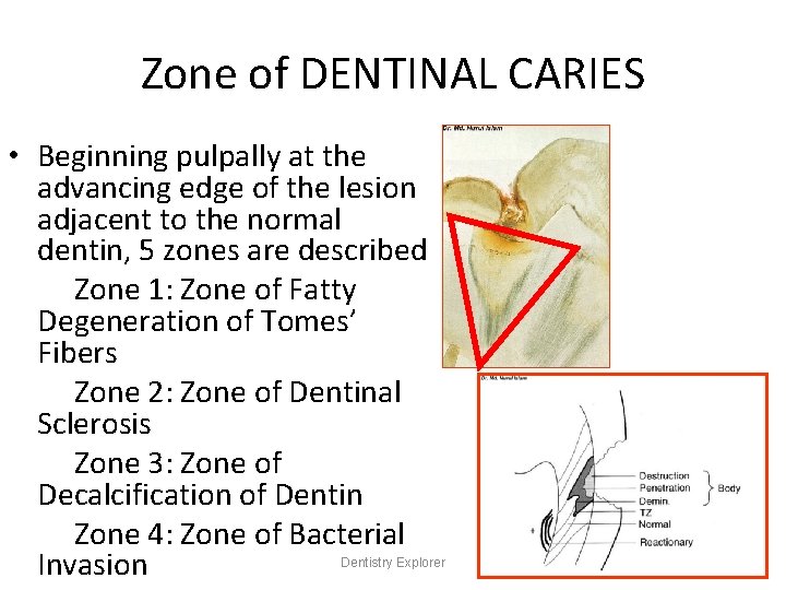 Zone of DENTINAL CARIES • Beginning pulpally at the advancing edge of the lesion
