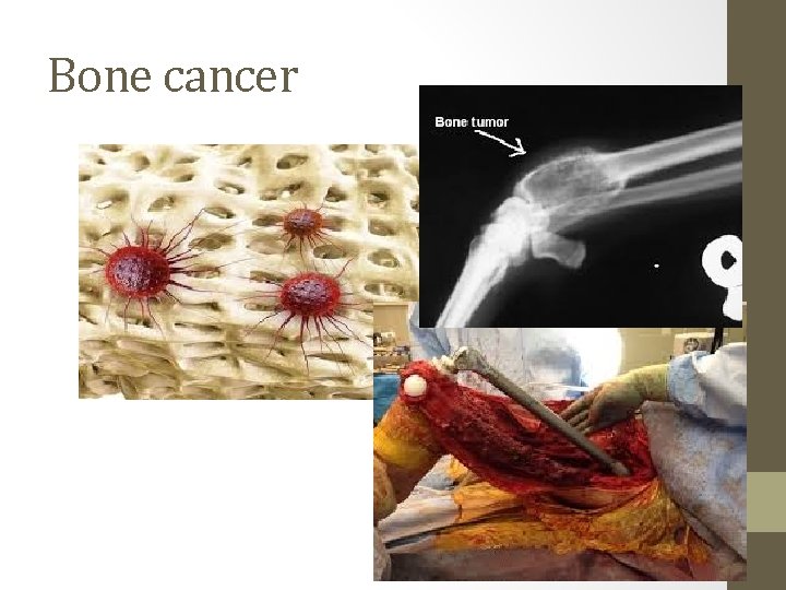 Bone cancer 