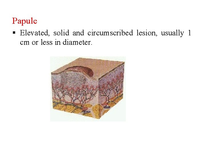 Papule § Elevated, solid and circumscribed lesion, usually 1 cm or less in diameter. Papule § Elevated, solid and circumscribed lesion, usually 1 cm or less in diameter.