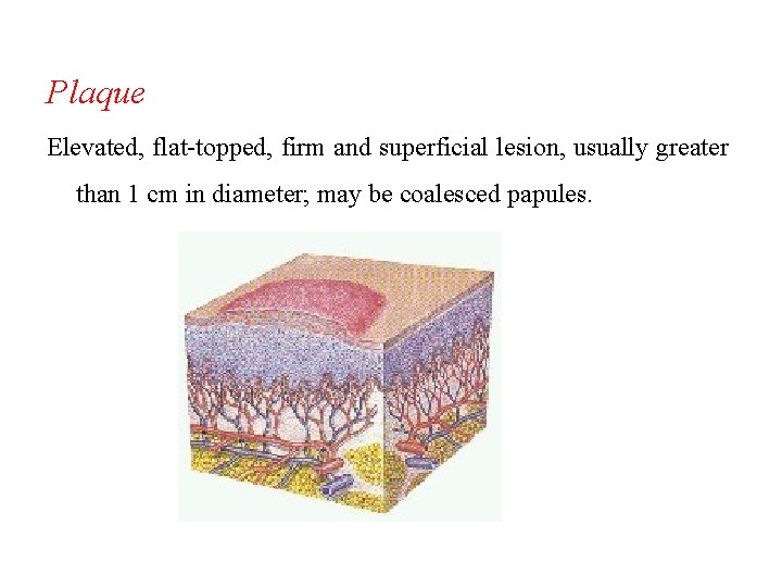 Plaque Elevated, flat-topped, firm and superficial lesion, usually greater than 1 cm in diameter; Plaque Elevated, flat-topped, firm and superficial lesion, usually greater than 1 cm in diameter;