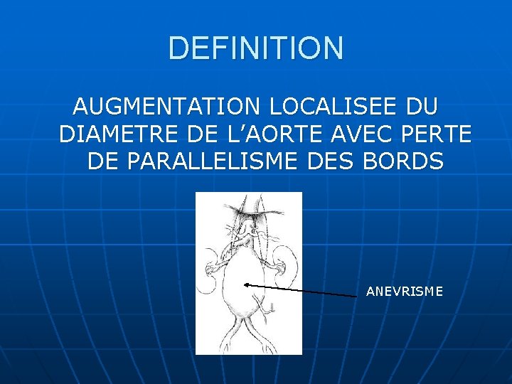 DEFINITION AUGMENTATION LOCALISEE DU DIAMETRE DE L’AORTE AVEC PERTE DE PARALLELISME DES BORDS ANEVRISME