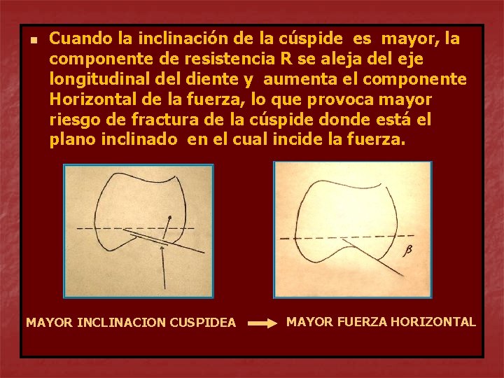 n Cuando la inclinación de la cúspide es mayor, la componente de resistencia R