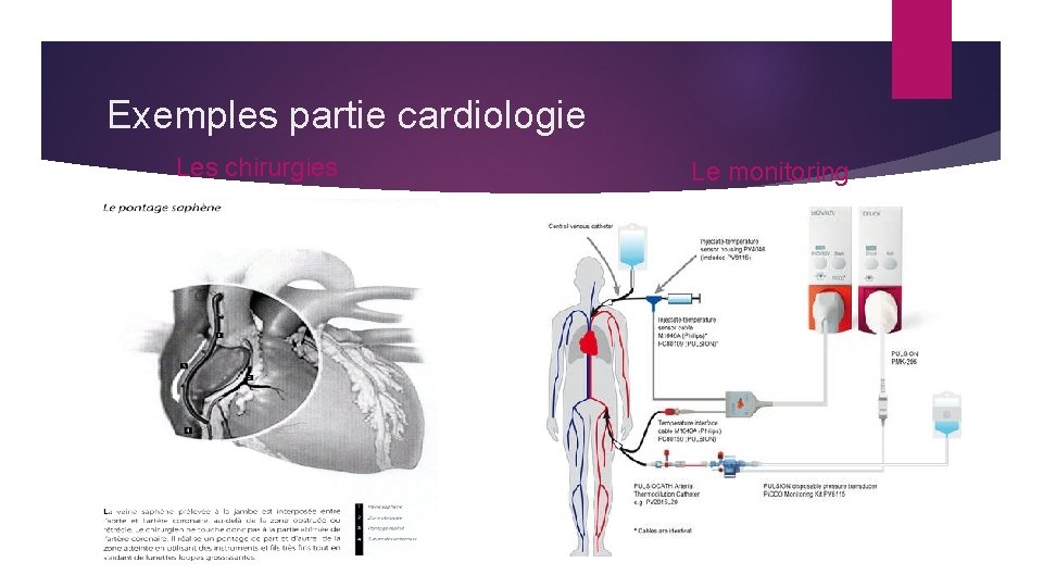 Exemples partie cardiologie Les chirurgies Le monitoring 