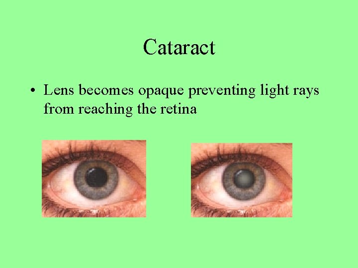 Cataract • Lens becomes opaque preventing light rays from reaching the retina 