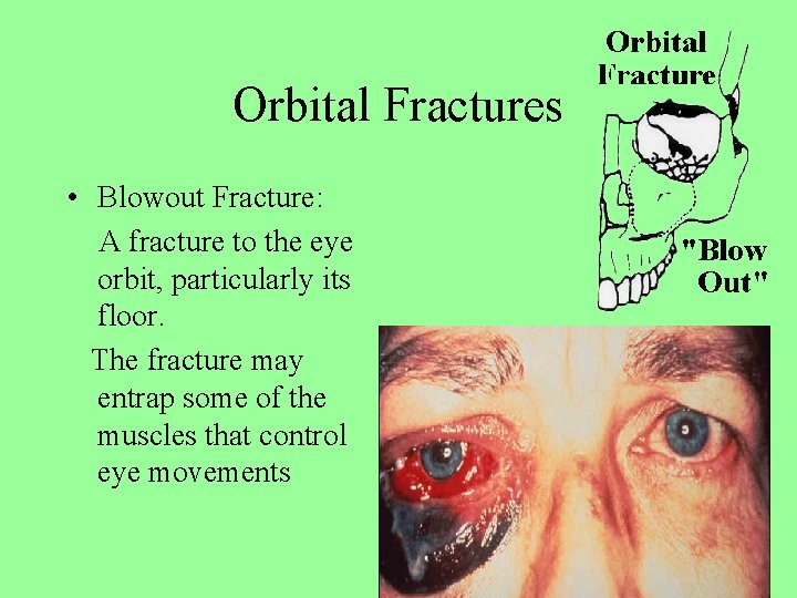 Orbital Fractures • Blowout Fracture: A fracture to the eye orbit, particularly its floor.