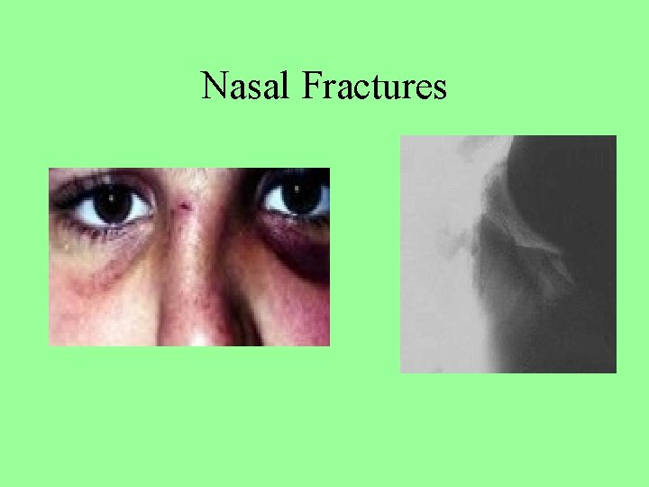 Nasal Fractures 