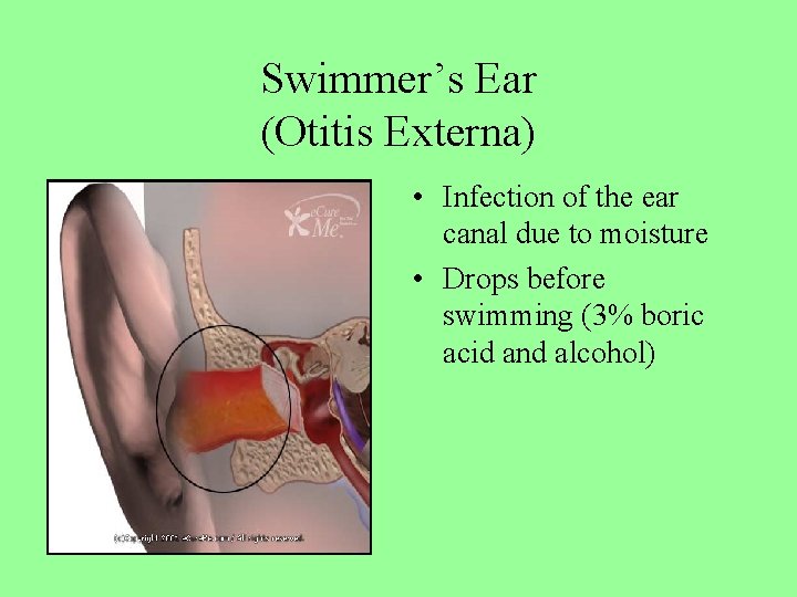 Swimmer’s Ear (Otitis Externa) • Infection of the ear canal due to moisture •