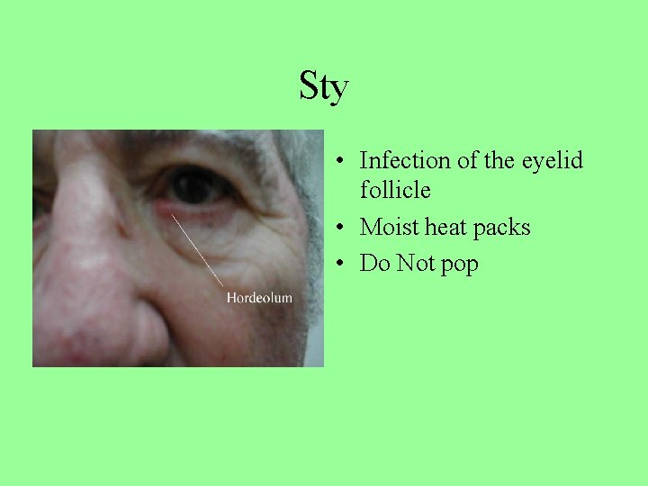 Sty • Infection of the eyelid follicle • Moist heat packs • Do Not