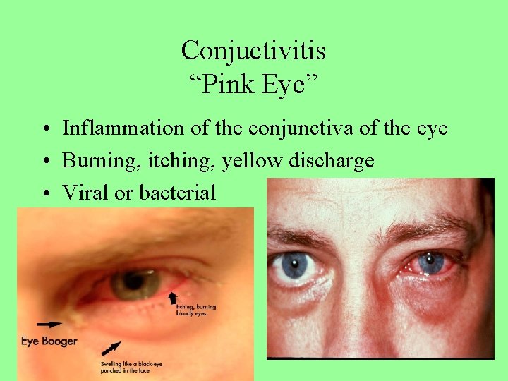 Conjuctivitis “Pink Eye” • Inflammation of the conjunctiva of the eye • Burning, itching,