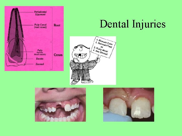 Dental Injuries 