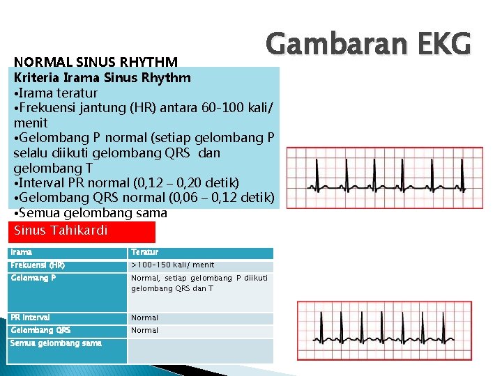 Gambaran EKG NORMAL SINUS RHYTHM Kriteria Irama Sinus Rhythm • Irama teratur • Frekuensi