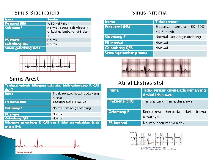 Sinus Bradikardia Irama Frekuensi (HR) Gelomang P PR Interval Gelombang QRS Semua gelombang sama