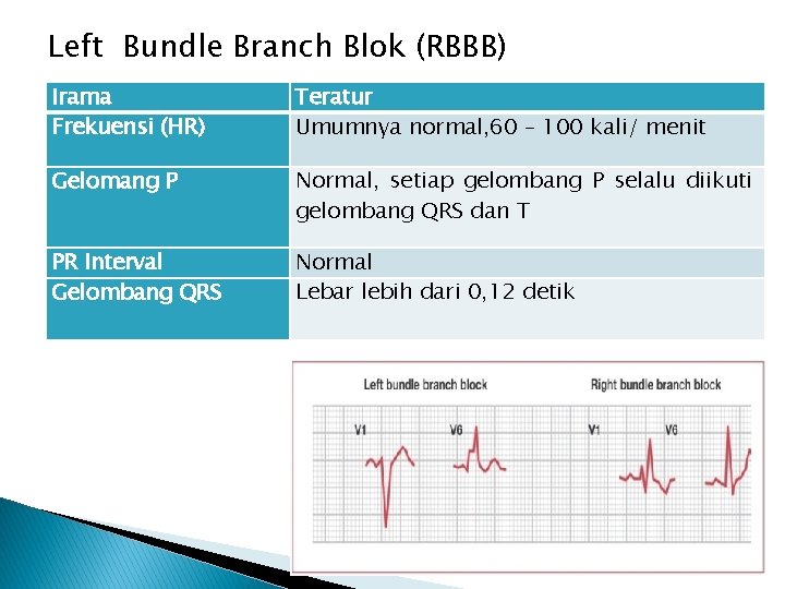 Left Bundle Branch Blok (RBBB) Irama Frekuensi (HR) Teratur Umumnya normal, 60 – 100