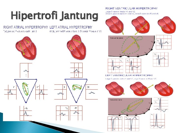 Hipertrofi Jantung 