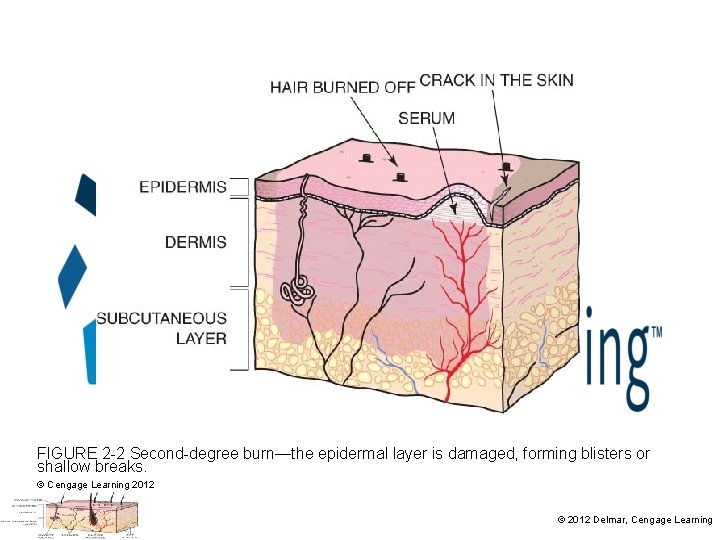 FIGURE 2 -2 Second-degree burn—the epidermal layer is damaged, forming blisters or shallow breaks.