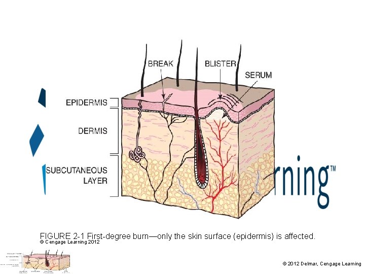 FIGURE 2 -1 First-degree burn—only the skin surface (epidermis) is affected. © Cengage Learning