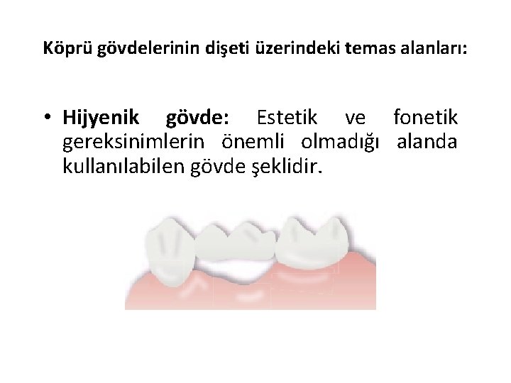 Köprü gövdelerinin dişeti üzerindeki temas alanları: • Hijyenik gövde: Estetik ve fonetik gereksinimlerin önemli