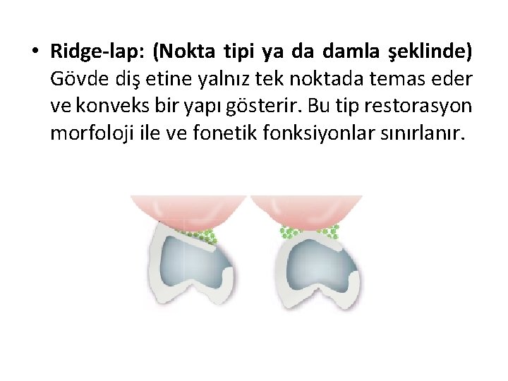  • Ridge-lap: (Nokta tipi ya da damla şeklinde) Gövde diş etine yalnız tek