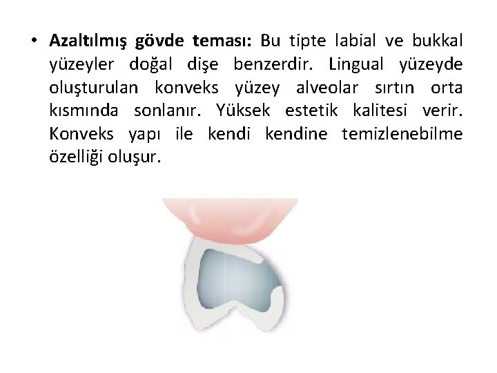  • Azaltılmış gövde teması: Bu tipte labial ve bukkal yüzeyler doğal dişe benzerdir.