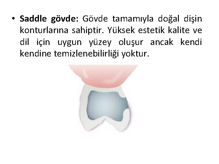  • Saddle gövde: Gövde tamamıyla doğal dişin konturlarına sahiptir. Yüksek estetik kalite ve