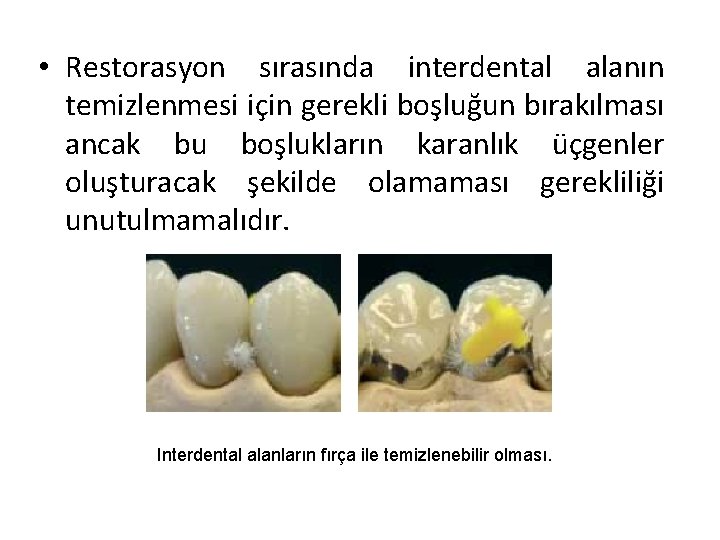  • Restorasyon sırasında interdental alanın temizlenmesi için gerekli boşluğun bırakılması ancak bu boşlukların