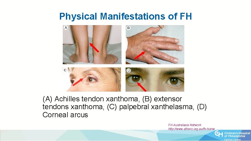Physical Manifestations of FH (A) Achilles tendon xanthoma, (B) extensor tendons xanthoma, (C) palpebral