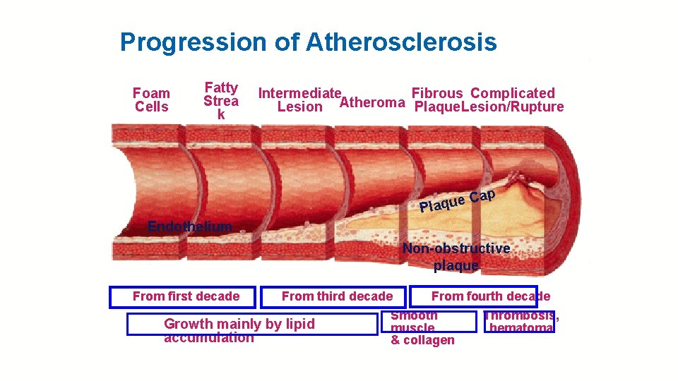 Progression of Atherosclerosis Foam Cells Fatty Strea k Intermediate Fibrous Complicated Lesion Atheroma Plaque.