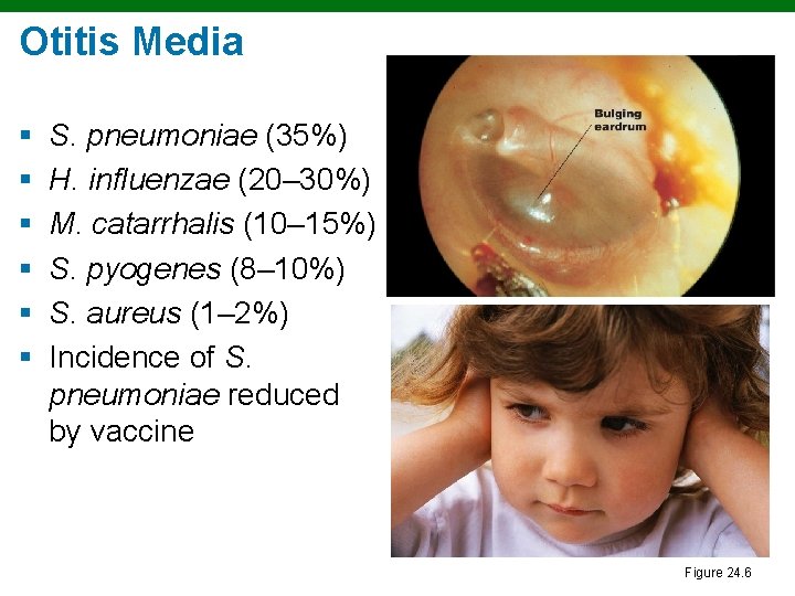 Otitis Media § § § S. pneumoniae (35%) H. influenzae (20– 30%) M. catarrhalis