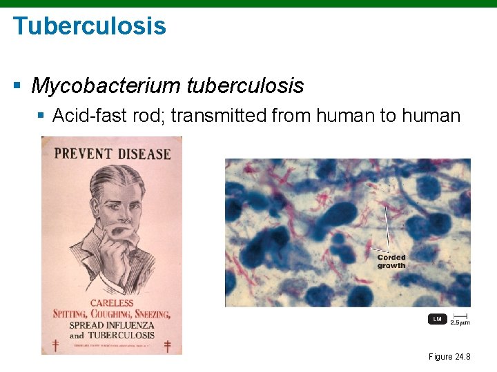 Tuberculosis § Mycobacterium tuberculosis § Acid-fast rod; transmitted from human to human Figure 24.