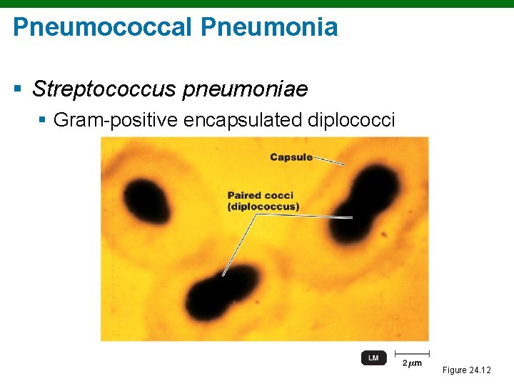 Pneumococcal Pneumonia § Streptococcus pneumoniae § Gram-positive encapsulated diplococci Figure 24. 12 