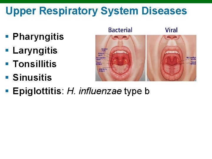 Upper Respiratory System Diseases § § § Pharyngitis Laryngitis Tonsillitis Sinusitis Epiglottitis: H. influenzae