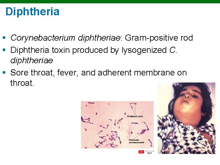 Diphtheria § Corynebacterium diphtheriae: Gram-positive rod § Diphtheria toxin produced by lysogenized C. diphtheriae
