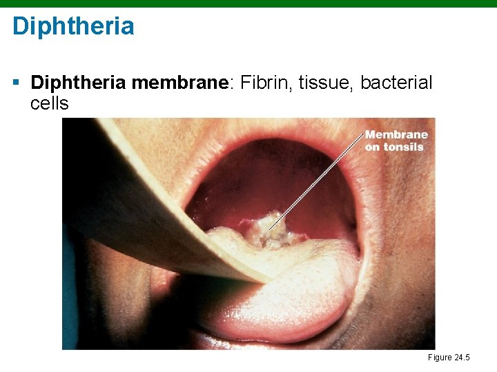 Diphtheria § Diphtheria membrane: Fibrin, tissue, bacterial cells Figure 24. 5 